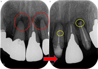 CBCTで側枝まで根管充填する！？（根管治療） - EE DENTAL_Blog